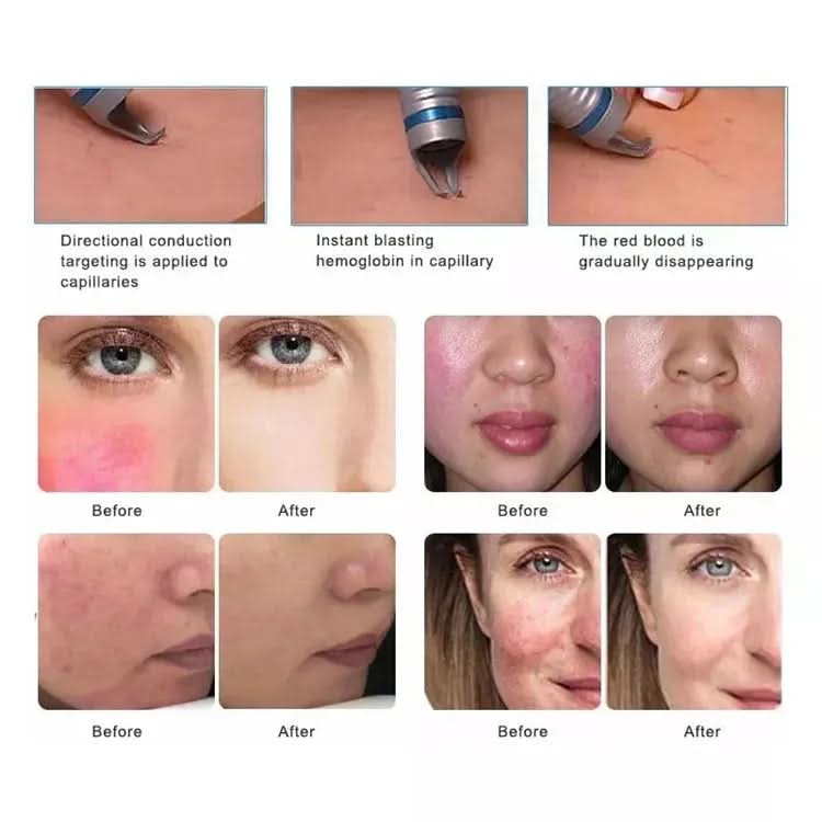 BEST 30W 5 in 1 980nm Diode Laser Vascular Removal Machine Remove Spider Veins 980 Diode Laser Blood Vessels Removal Nail Fungus