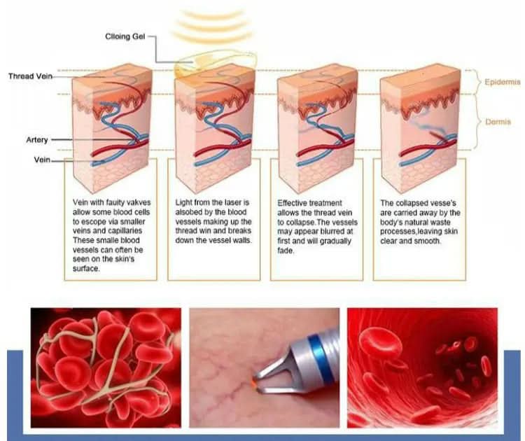 BEST 30W 5 in 1 980nm Diode Laser Vascular Removal Machine Remove Spider Veins 980 Diode Laser Blood Vessels Removal Nail Fungus